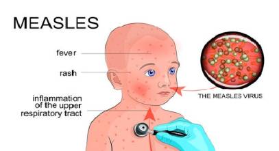 Measles - Copy